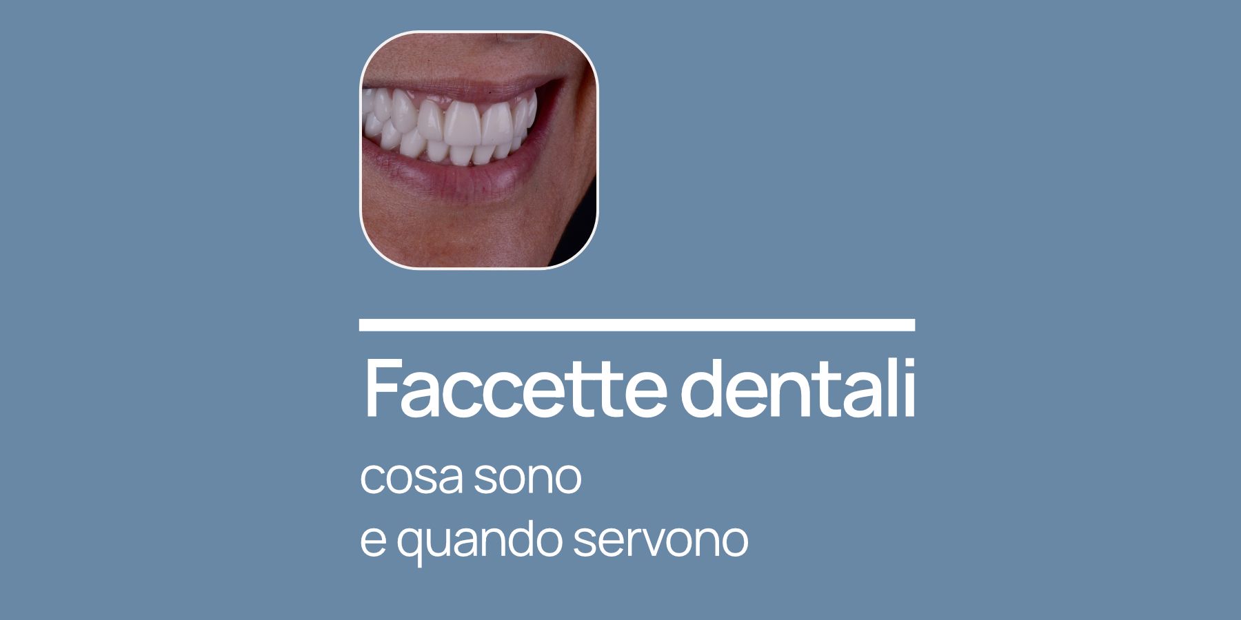Faccette dentali estetiche